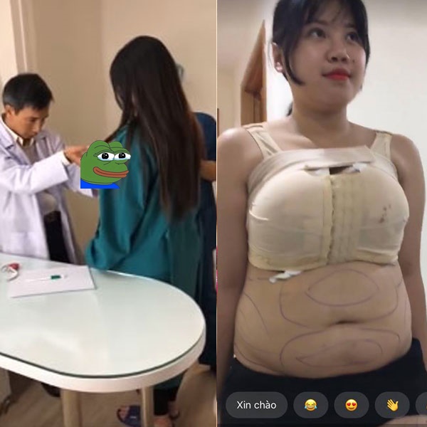 Just liposuction to shrink 1m1 breasts, the Vietnamese hot girl's super bust is shocking when she continues to beat and rebuild - Photo 2.