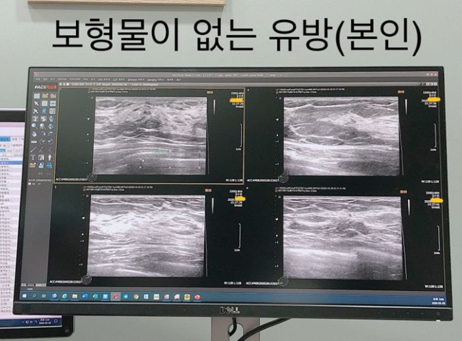 Bị nghi ngờ dao kéo, nữ streamer thẳng thừng tới bệnh viện, livestream công khai chứng minh- Ảnh 5.