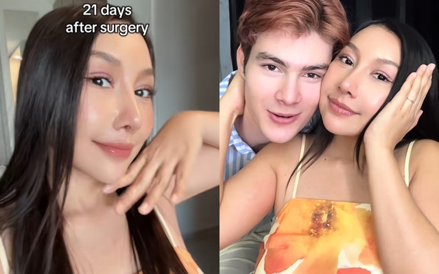 Gương mặt sau 21 ngày phẫu thuật thẩm mỹ của cô vợ cao 1m55 áp lực vì chồng Tây quá đẹp trai, cao gần 2m- Ảnh 5.