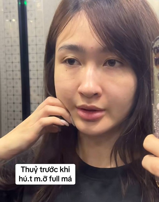 Mỹ nhân SN 2001 đóng phim giờ vàng VTV công khai dung mạo sau khi hút mỡ mặt- Ảnh 2.