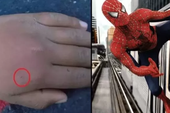 Cho nhện cắn với mong ước trở thành Spider-Man, nam game thủ nhập viện khẩn cấp