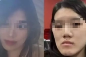 Cô gái bị biến dạng khuôn mặt sau PTTM, bi kịch đau khổ vì quyết định sai lầm