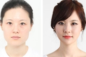 Chùm ảnh về trước và sau phẫu thuật thẩm mỹ tại Hàn Quốc