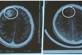 Đã có cách làm trì hoãn sự phát triển của u não