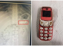 Nuốt nguyên chiếc điện thoại Nokia, nam game thủ đau bụng dữ dội, tới viện khẩn cầu bác sĩ và cái kết