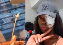 Dùng sạc điện thoại xoắn, hở dây, cô nàng game thủ bị tia lửa điện bắn vào mắt, gây bỏng giác mạc