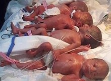 Sản phụ lúc siêu âm thấy 7 em bé, đến lúc đẻ liên tiếp 9 đứa mới dừng