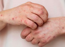 Tại sao cơ thể của chúng ta lại bị dị ứng?