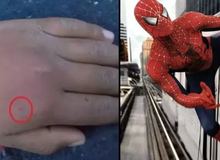 Cho nhện cắn với mong ước trở thành Spider-Man, nam game thủ nhập viện khẩn cấp