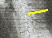 Cô gái 20 tuổi sở hữu cột sống cổ của người 60 vì nghiện chơi game