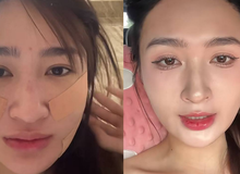 Mỹ nhân SN 2001 đóng phim giờ vàng VTV công khai dung mạo sau khi hút mỡ mặt