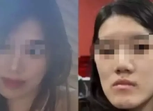 Cô gái bị biến dạng khuôn mặt sau PTTM, bi kịch đau khổ vì quyết định sai lầm
