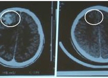 Đã có cách làm trì hoãn sự phát triển của u não