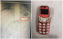 Nuốt nguyên chiếc điện thoại Nokia, nam game thủ đau bụng dữ dội, tới viện khẩn cầu bác sĩ và cái kết