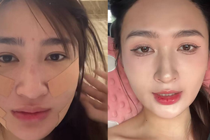 Mỹ nhân SN 2001 đóng phim giờ vàng VTV công khai dung mạo sau khi hút mỡ mặt