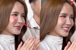 Gương mặt nhiều di chứng thẩm mỹ của Thiều Bảo Trâm đang khiến nhiều người lo lắng