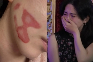 Nữ thần sắc đẹp showbiz bị bỏng mặt nghiêm trọng hậu thẩm mỹ, nhìn tình hình hiện tại mà xót thay