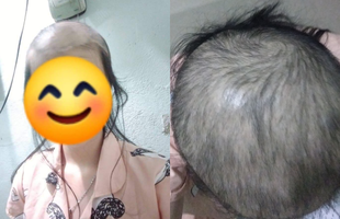 Cô gái hễ bị stress là nhổ tóc, nhìn tình cảnh bây giờ, ai cũng phải sợ hãi khuyên can hết lời