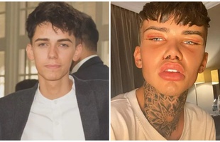 Tự thấy bản thân quá đẹp trai, anh chàng đầu tư gần 1 tỷ phẫu thuật cho "bớt bảnh bao", CĐM chỉ biết lắc đầu ngán ngẩm