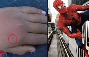 Cho nhện cắn với mong ước trở thành Spider-Man, nam game thủ nhập viện khẩn cấp