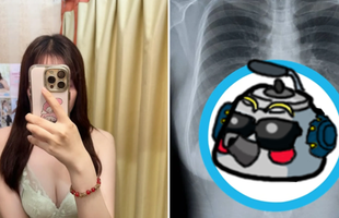 Khoe ảnh chụp X-quang vòng một, cô nàng streamer hút hơn 1,25 triệu lượt xem, CĐM dậy sóng chỉ trích
