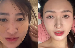 Mỹ nhân SN 2001 đóng phim giờ vàng VTV công khai dung mạo sau khi hút mỡ mặt