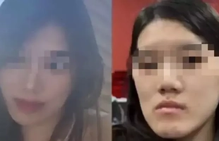 Cô gái bị biến dạng khuôn mặt sau PTTM, bi kịch đau khổ vì quyết định sai lầm
