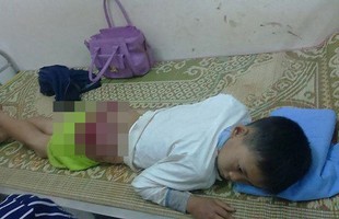 Xót xa bé 13 tuổi bị bố đánh bầm dập, mông rướm máu do bỏ học đi chơi điện tử