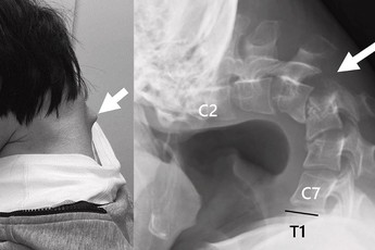 Nam game thủ "vẹo cổ" do chơi game, nhìn ảnh chụp phim mà... rợn người