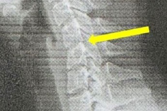 Cô gái 20 tuổi sở hữu cột sống cổ của người 60 vì nghiện chơi game