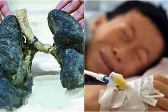 Anh chàng bị thối toàn bộ phổi vì ngồi quán net suốt 6 năm trời