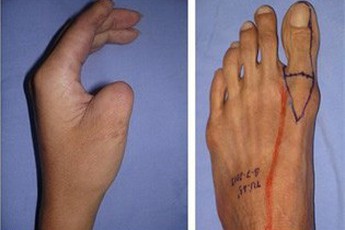 Việt Nam thực hiện thành công phẫu thuật siêu khó tầm cỡ quốc tế: lấy ngón CHÂN cái thay cho ngón TAY cái để phục hồi chức năng bàn tay!
