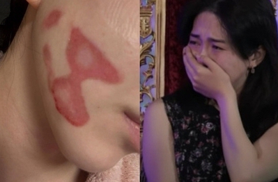 Nữ thần sắc đẹp showbiz bị bỏng mặt nghiêm trọng hậu thẩm mỹ, nhìn tình hình hiện tại mà xót thay