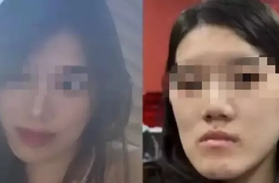 Cô gái bị biến dạng khuôn mặt sau PTTM, bi kịch đau khổ vì quyết định sai lầm